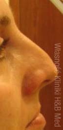 nieoperacyjna korekcja nosa
