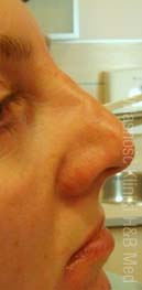 nieoperacyjna korekcja nosa